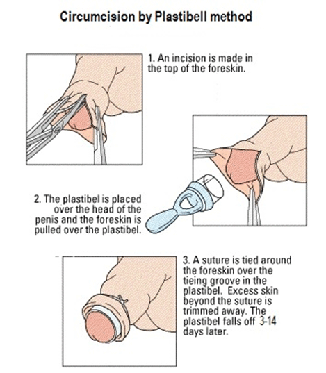 Circumcision – Eravio Hospital